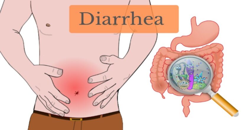 What is the best anti diarrhea medicine?